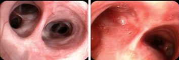 healthy &amp; inflamed lungs